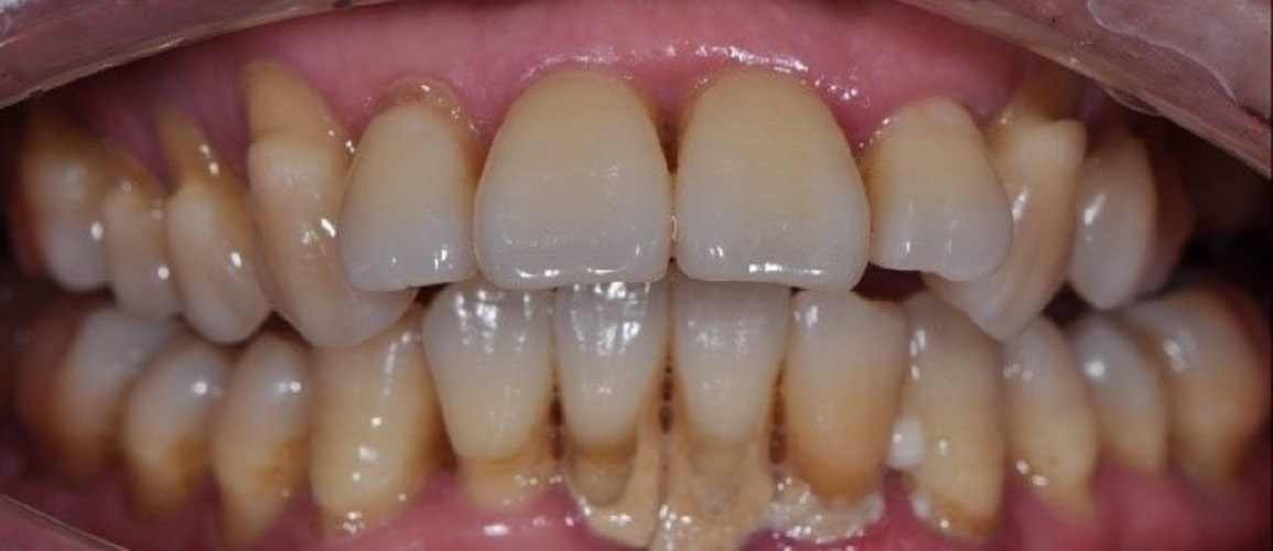 牙周炎图片_牙周炎症状表现图片大全_有来医生