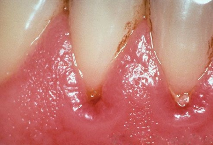 牙根炎症状图片
