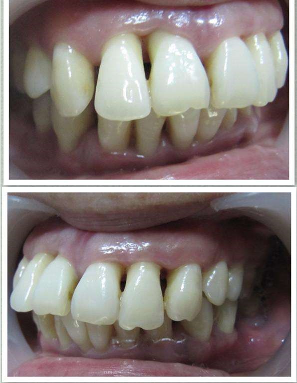 慢性牙周炎普遍图片