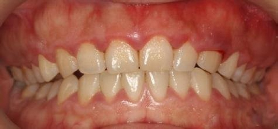 牙周炎的症状表现图片图片