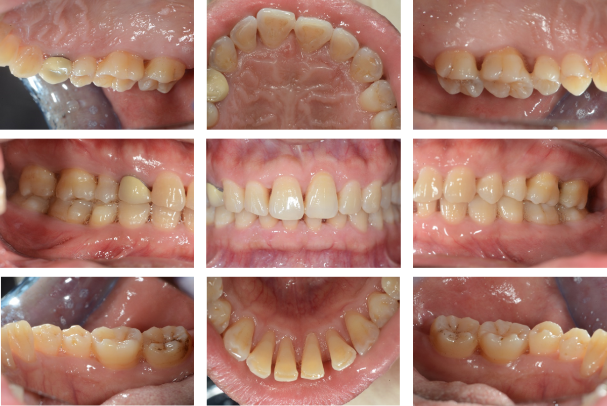 慢性牙周炎症状略轻图片
