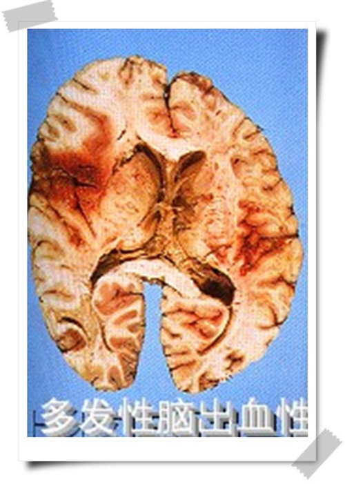 多发性脑出血性脑梗塞图片