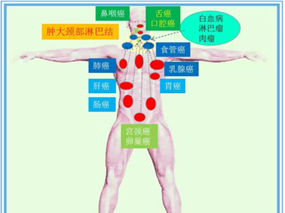 警惕十大癌变信号 别让癌症阴谋得逞