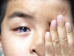 婴儿角膜炎的症状图片图片