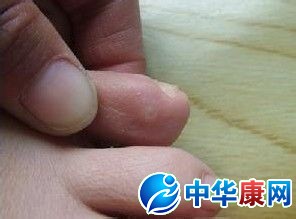 腳上長了雞眼怎麼治