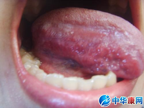 舌头初期小疣体图片图片