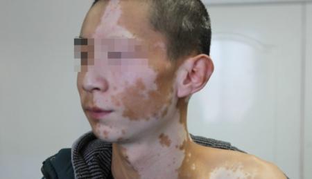 专家说:面部白癜风的症状和护理方式