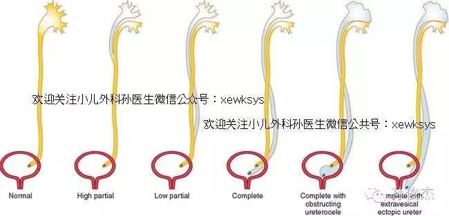 重复肾,可不是简单多个肾