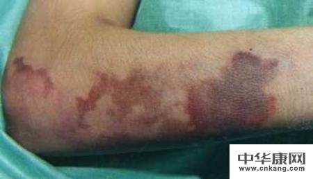 血小板减少性紫癜 用药 经验:         首先,血小板减少性紫癜的症状