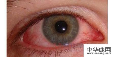 五官科 红眼病 传染         您好,患者朋友.