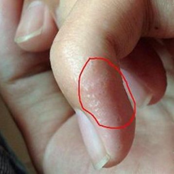 手指汗疱疹 初期图片