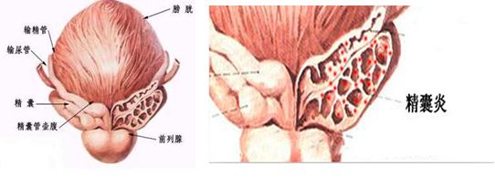 精囊炎.jpg