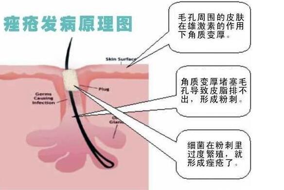 新闻 疾病科普  毛囊中存在的痤疮棒状杆菌,白色葡萄球菌和卵圆形糠疹