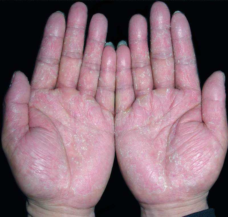 湿疹型手气的症状图片图片