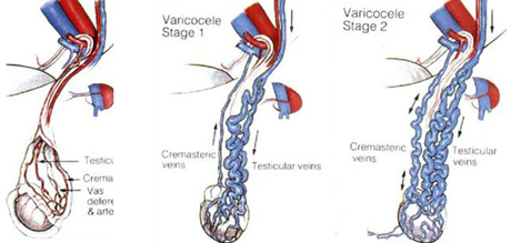 精索静脉曲张位置图片图片