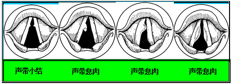 聲帶息肉是由長期發聲不當,不良刺激或慢性炎症引發的