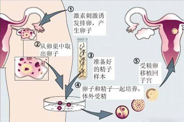 试管婴儿流程_副本.jpg