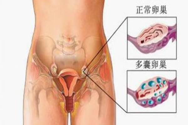 多囊_副本.jpg